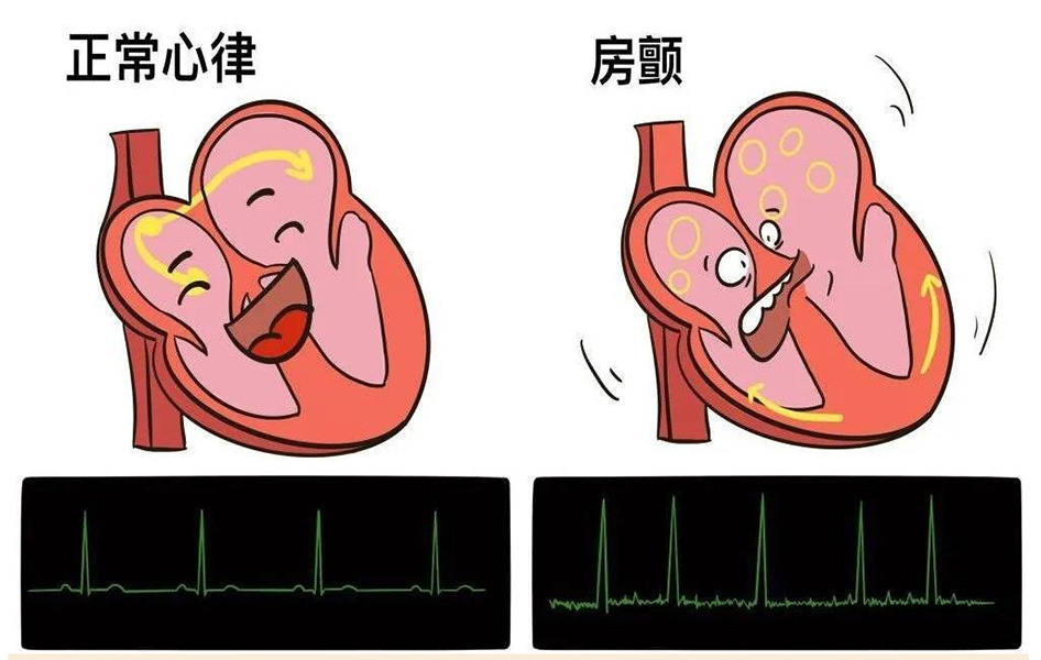 96120非急救转运中心病例小百科：房颤是否容易引发脑梗？